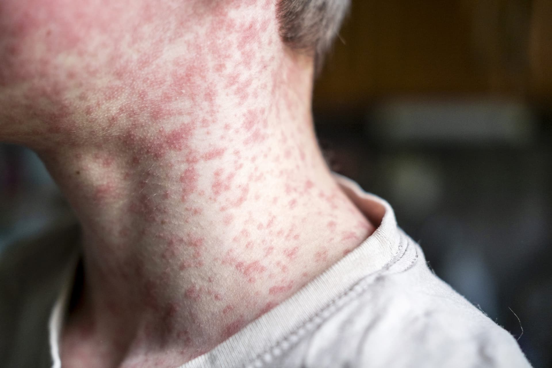 Measles outbreak in Southwest Wisconsin grows; most taken ill weren’t vaccinated