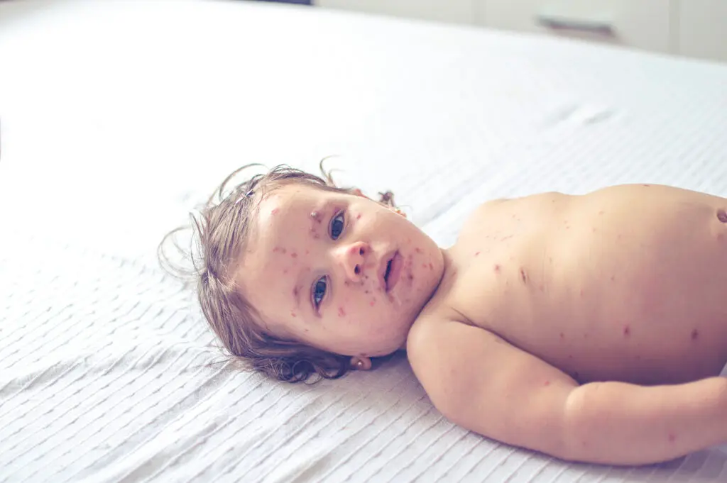 Measles spread in Wisconsin; almost everyone made ill is unvaccinated, health officials say